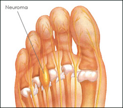 Morton’s Neuroma: What is it and How to Stop the Pain