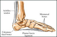 Plantar Fasciitis: Put Your Heel Pain to a Halt
