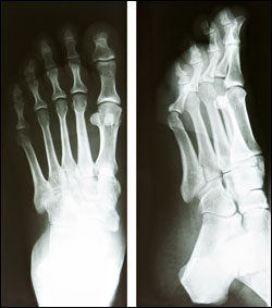 Stress Fractures: Don’t Put Off Painful Foot Injuries