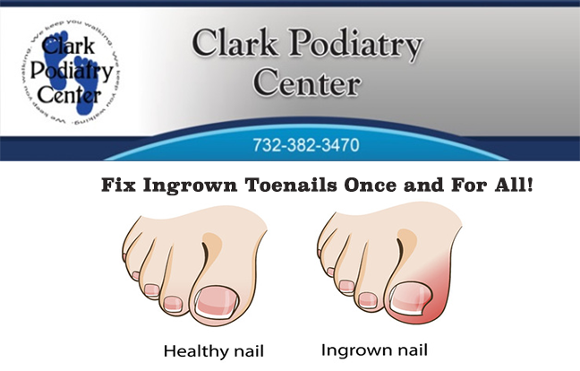 Fix Ingrown Toenails Once and For All!