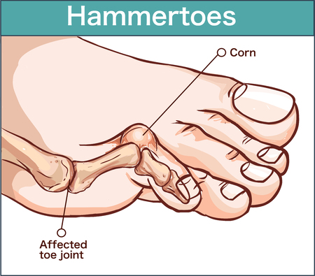 Hammering Out Hammertoes