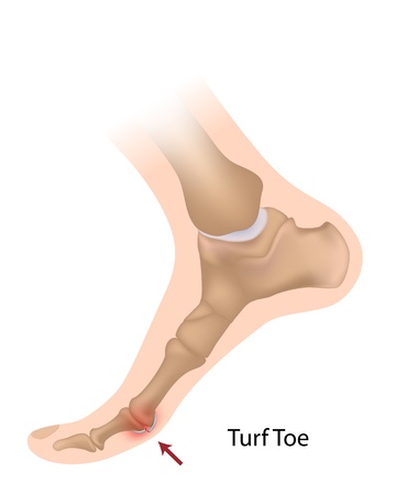 Treating Turf Toe