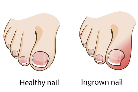 What’s Going On With My Ingrown Toenail?