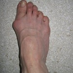 Where Did My Bunions Come From?