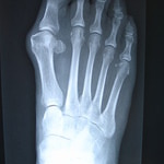 Xraybunionright